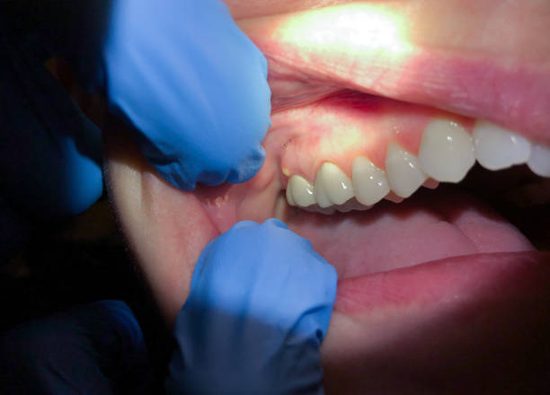 Best Emergency Broken Tooth Repair in Cambridge, OH