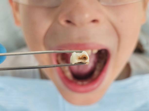 Best Emergency Tooth Extraction in Cambridge, OH